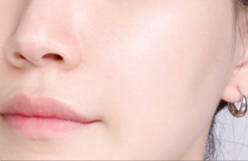 사용 후 — 같은 자리의 볼과 입가 근접 사진