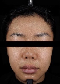 피부 밝기 대표 사진 — 2주 사용 후, 검은 배경 정면 얼굴(눈 가림)